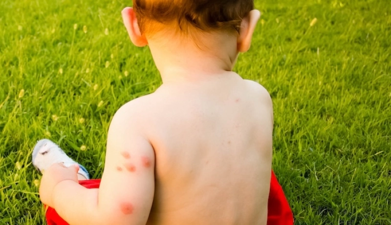 Piqure de moustiques bebe